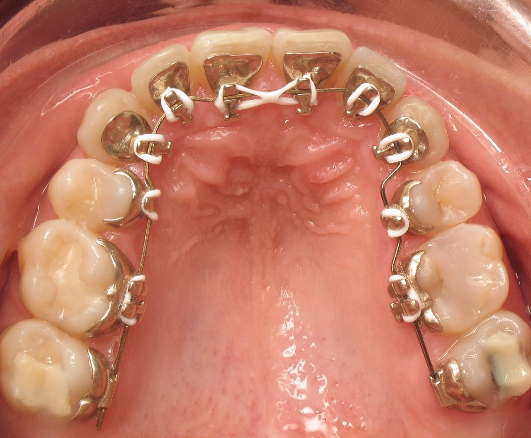 Orthodontie linguale Lille
