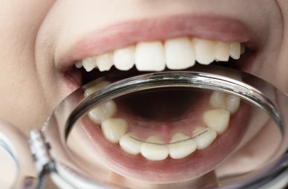 Contention au Cabinet Flandres Orthodontie des Drs Biecq-Sellier & Payart à Lille