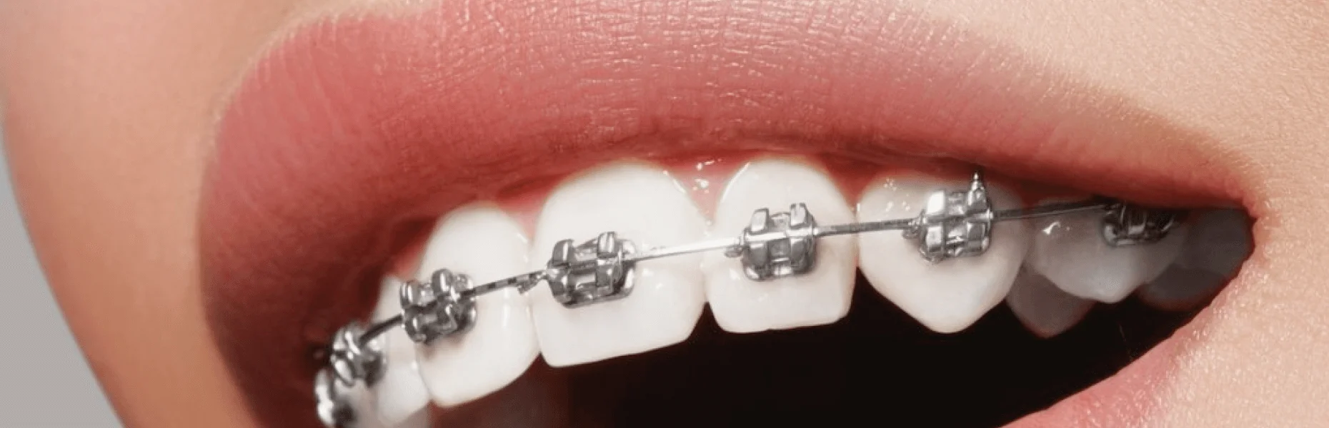 Résolution des incidents d'orthodontie à Lille : Flandres Orthodontie