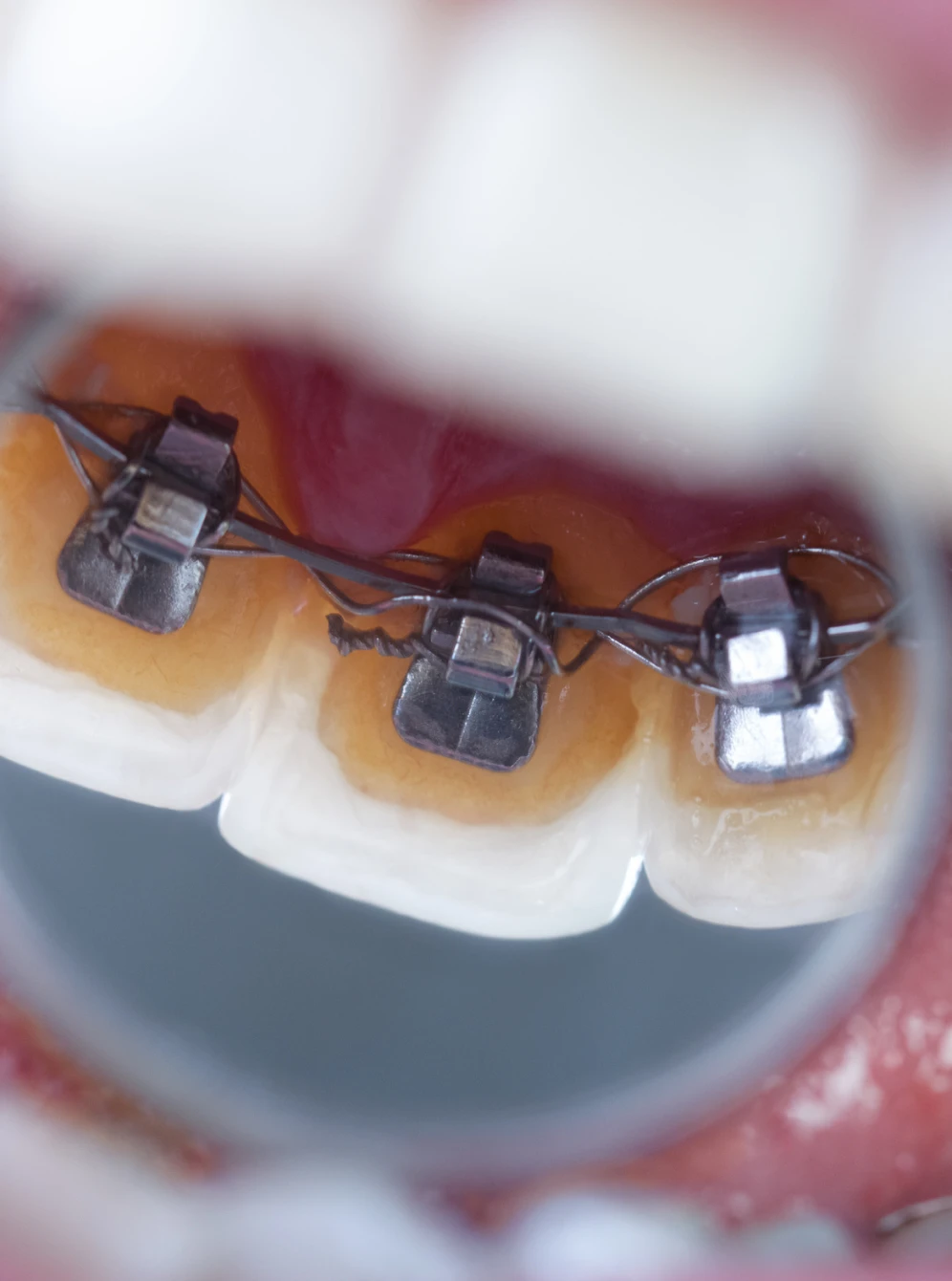 Orthodontie linguale aux Cabinets Flandres Orthodontie des Drs Marion Biecq-Sellier & Etienne Payart