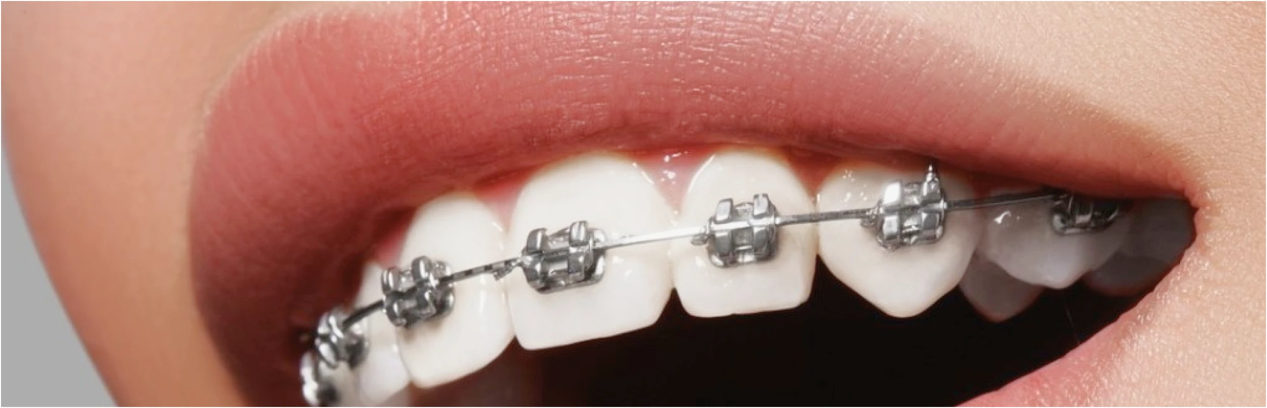 Résolution des incidents d'orthodontie à Lille : Flandres Orthodontie